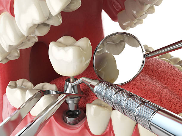 Best Emergency Tooth Extraction in Smithville, TX